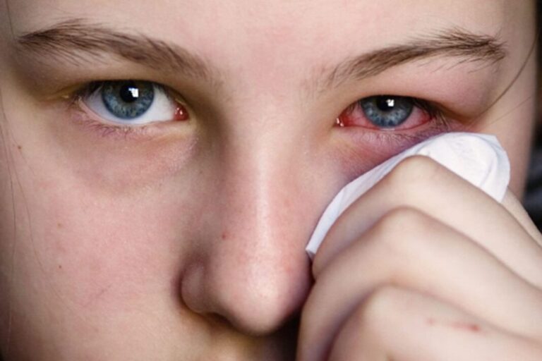 How to Deal with the Conjunctivitis Menace